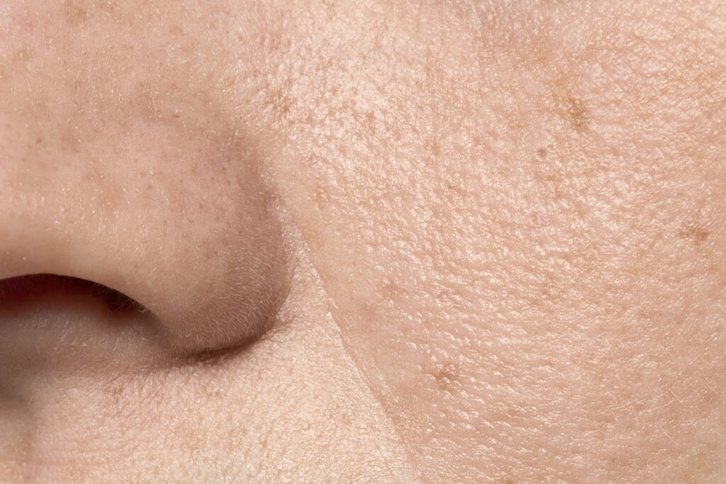 Close-up of enlarged pores on nose and cheeks showing uneven skin texture