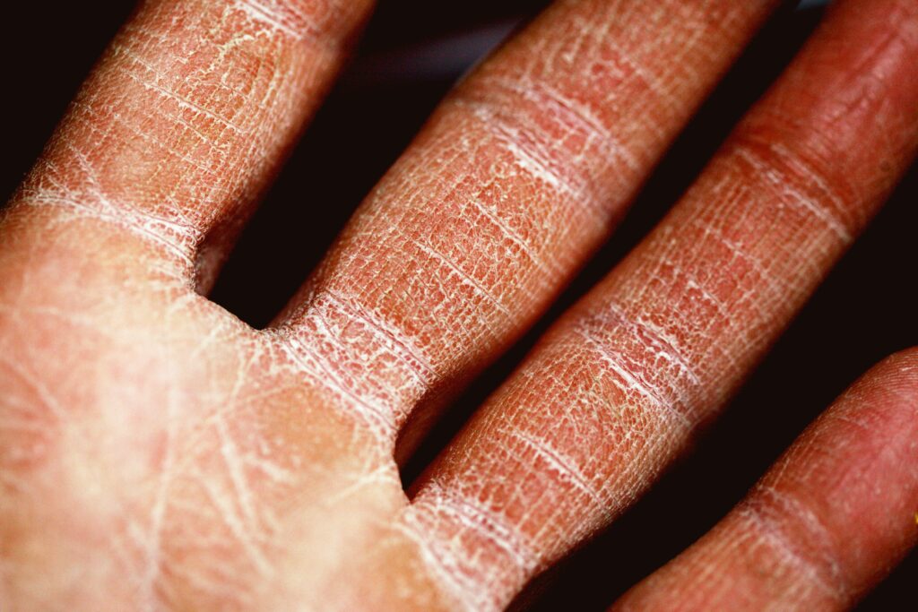 Close-up of very dry, cracked skin on fingers showing chronically dehydrated skin and a damaged barrier