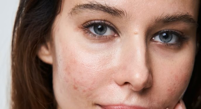 Close-up of a young woman's face showing inflammatory acne lesions on the cheek — illustrating types of acne including papules and pustules
